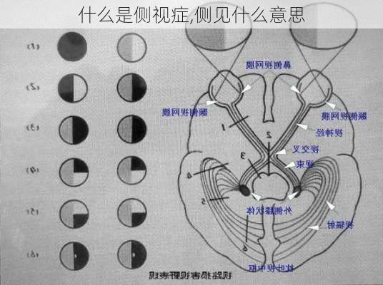 什么是侧视症,侧见什么意思