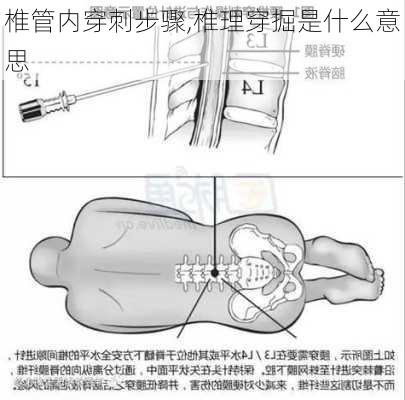 椎管内穿刺步骤,椎理穿掘是什么意思