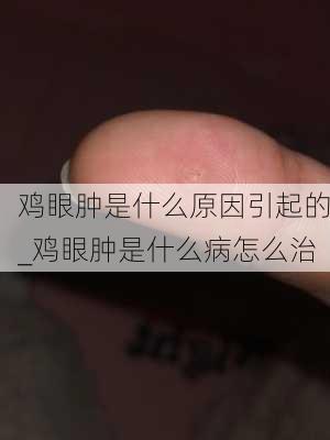 鸡眼肿是什么原因引起的_鸡眼肿是什么病怎么治