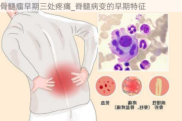 骨髓瘤早期三处疼痛_脊髓病变的早期特征